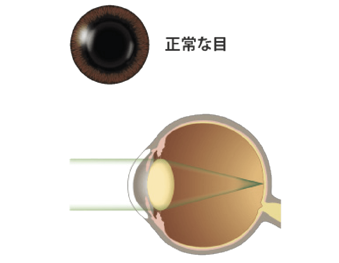 正常な透明の水晶体は、外からの光を集めてピントを合わせる働きをします。