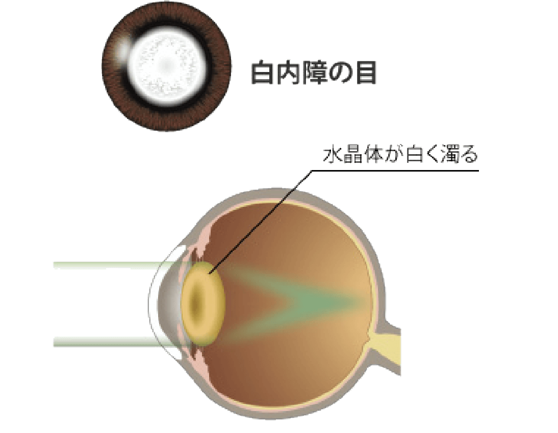 濁った水晶体は光が正常に通過しないので、乱反射して眩しく感じたりピントが合わずぼんやり見えたりします。