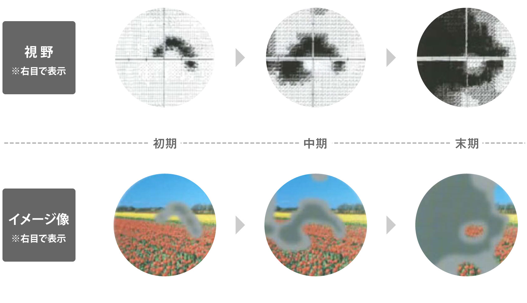 自動視野計で測定した、初期から末期までの視野の変化